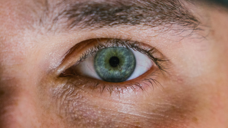 Under Eye Dark Circles – 5 Natural Remedies Available At Home